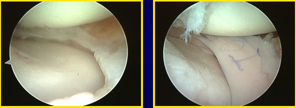 arthroscopic knee meniscus surgery burning sensation meniscus arthroscopic