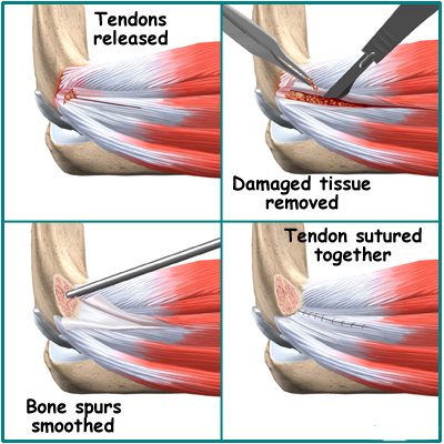 Steroid use after shoulder surgery