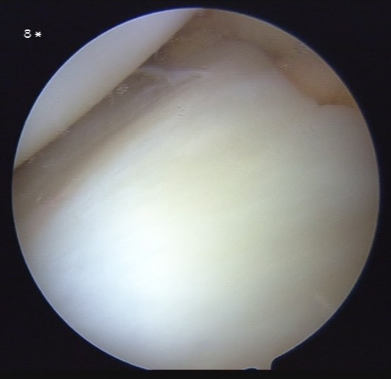 Knee Pain - Could it be a Meniscus Tear? (3/6)