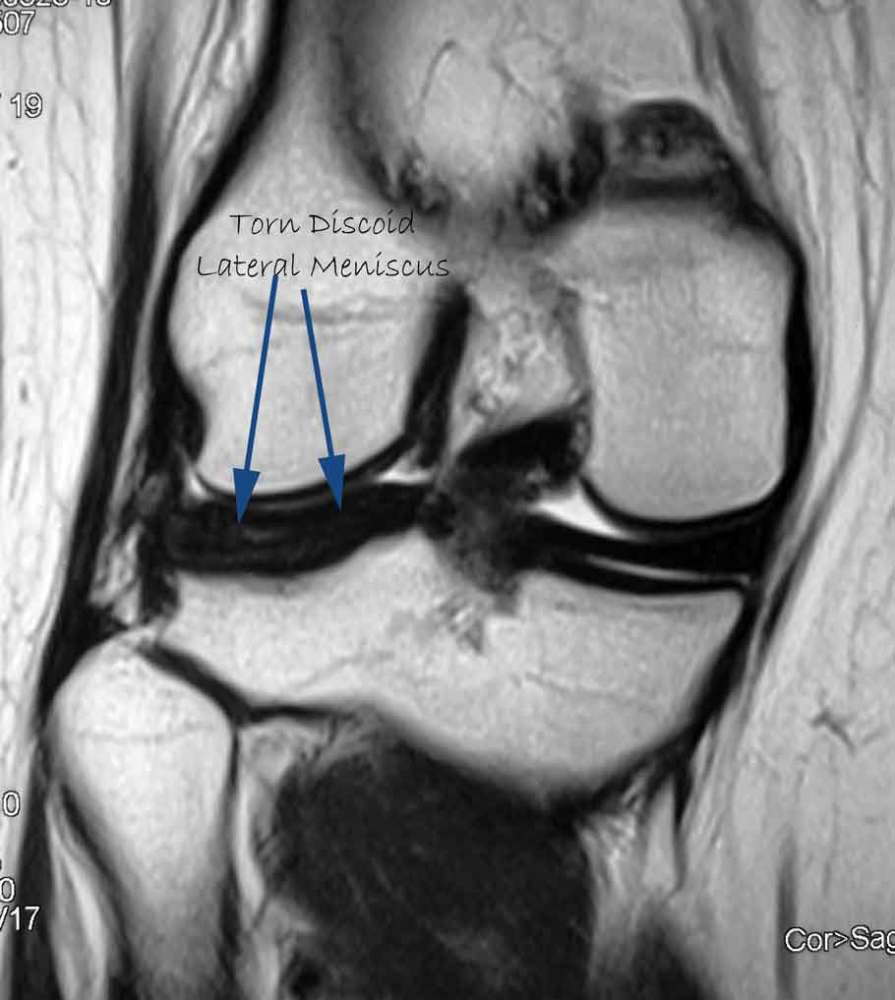 Discoid Meniscus - What To Do If It Is Torn? (2/6)