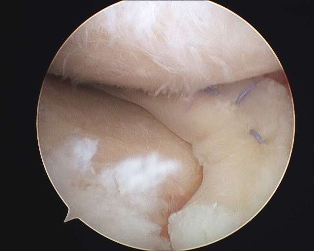 Medial Meniscus Transplant by Dr HC Chang