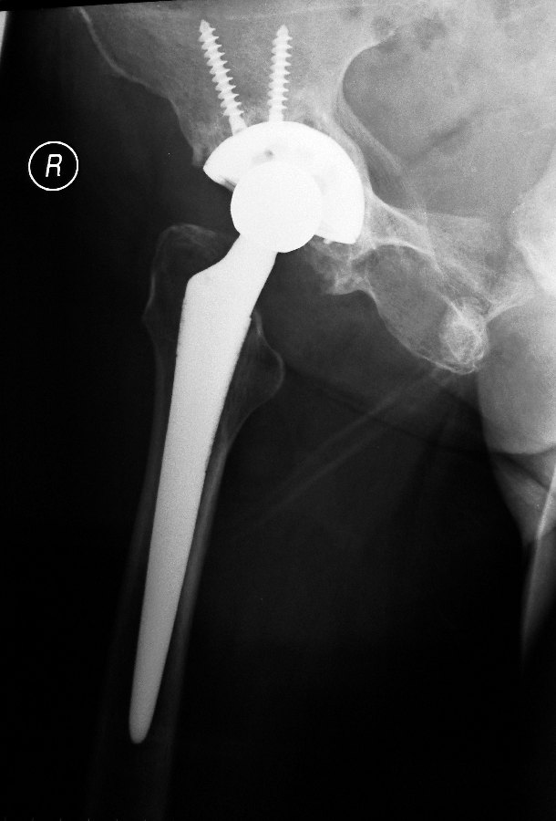 X-rays of Total Hip Replacement