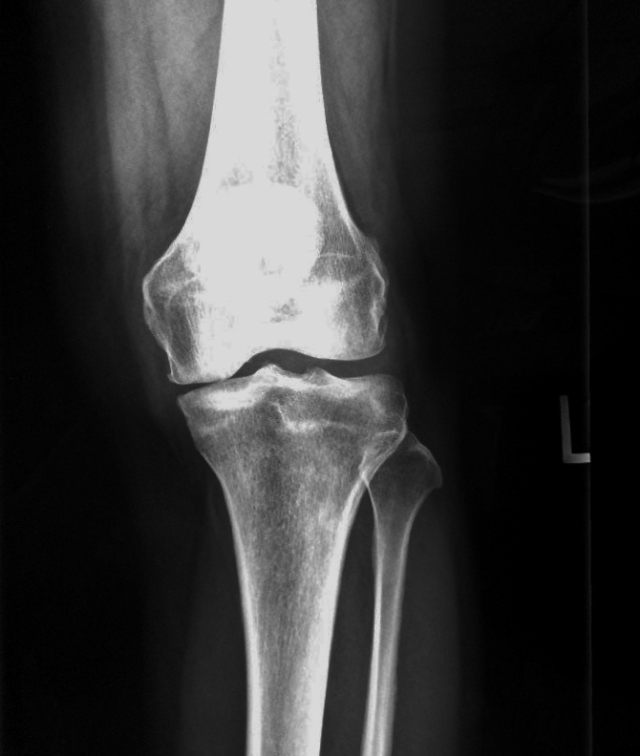 Medial Compartment Knee Pain