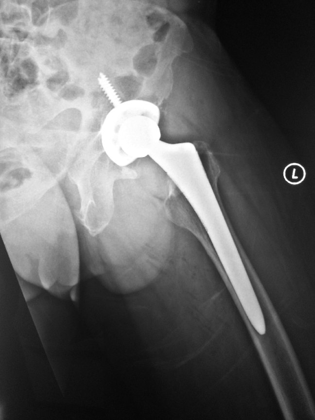 Total Hip Replacement | HC Chang